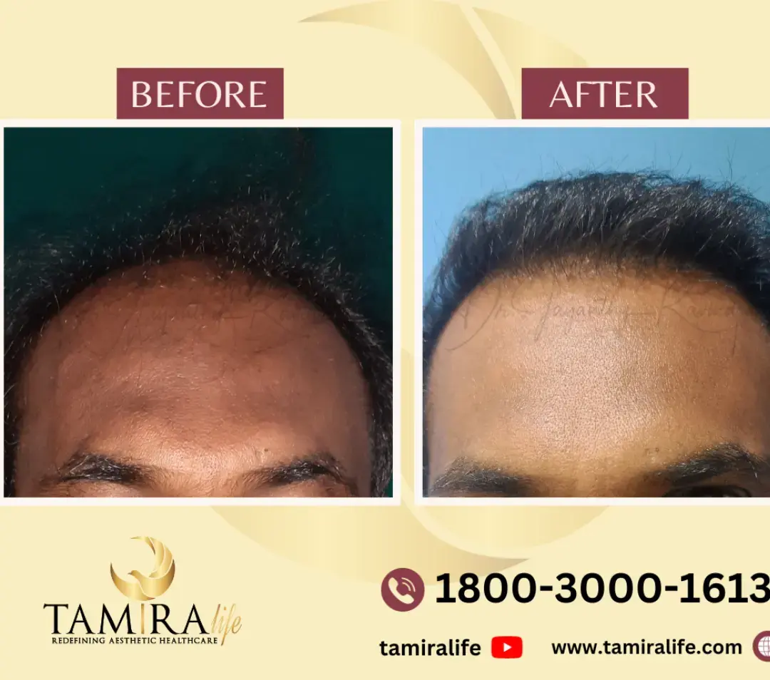 Hair Transplant - Before & After
