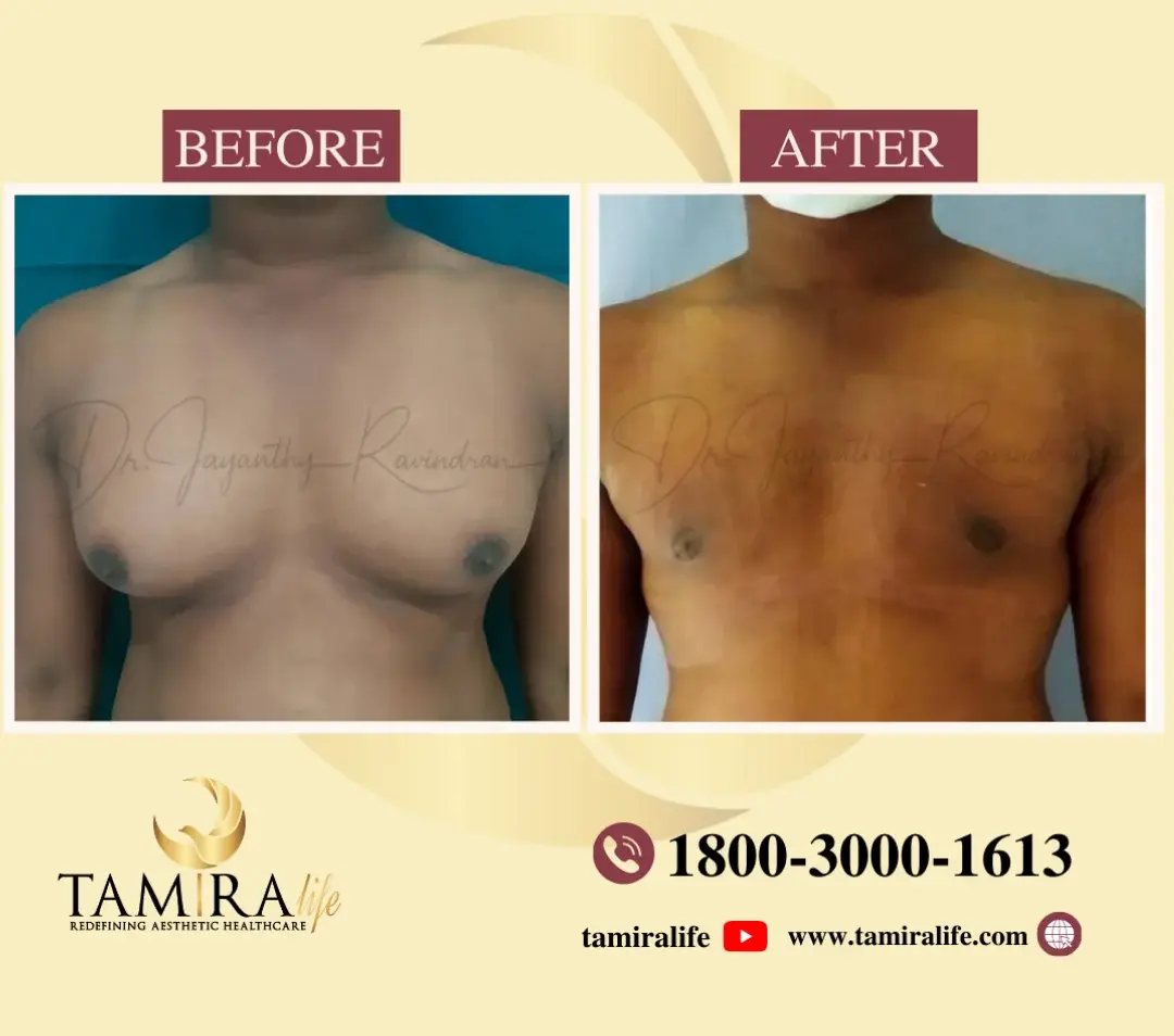 GYNECOMASTIA SURGERY Before and After