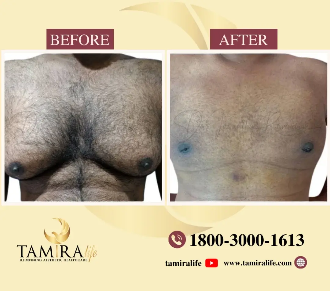 GYNECOMASTIA SURGERY Before and After