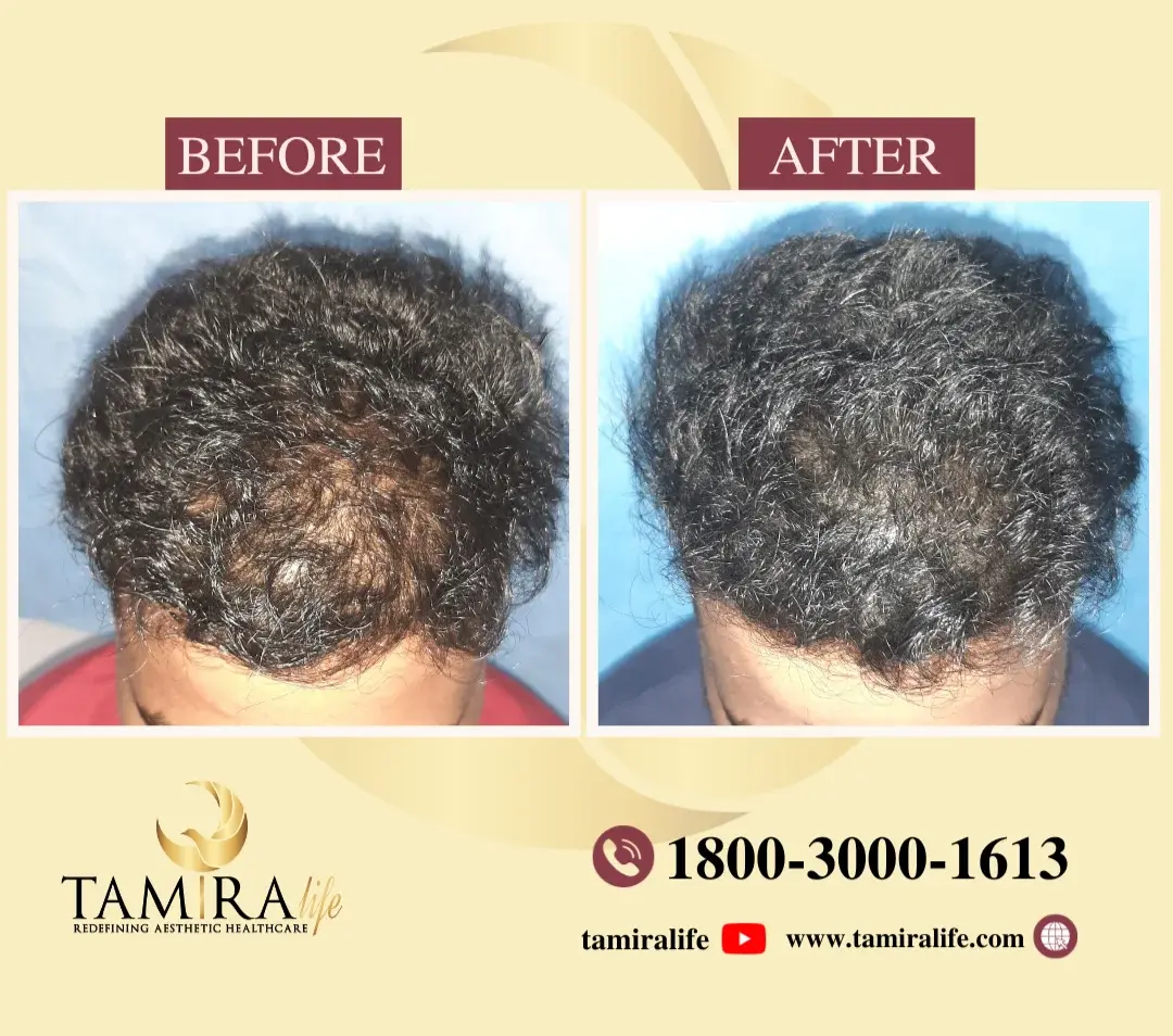 SCALP MICROPIGMENTATION BEFORE AND AFTER