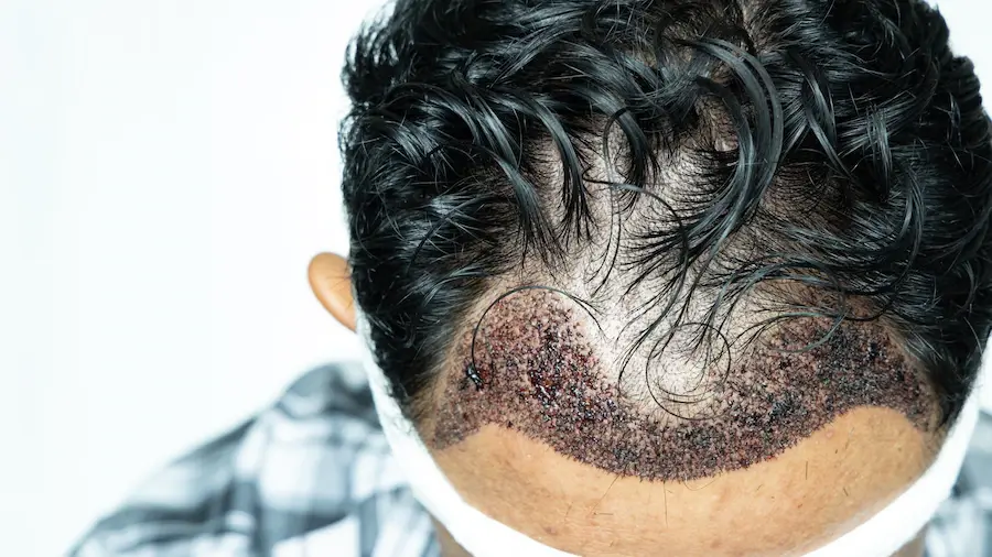 Itching Occur After Hair Transplantation