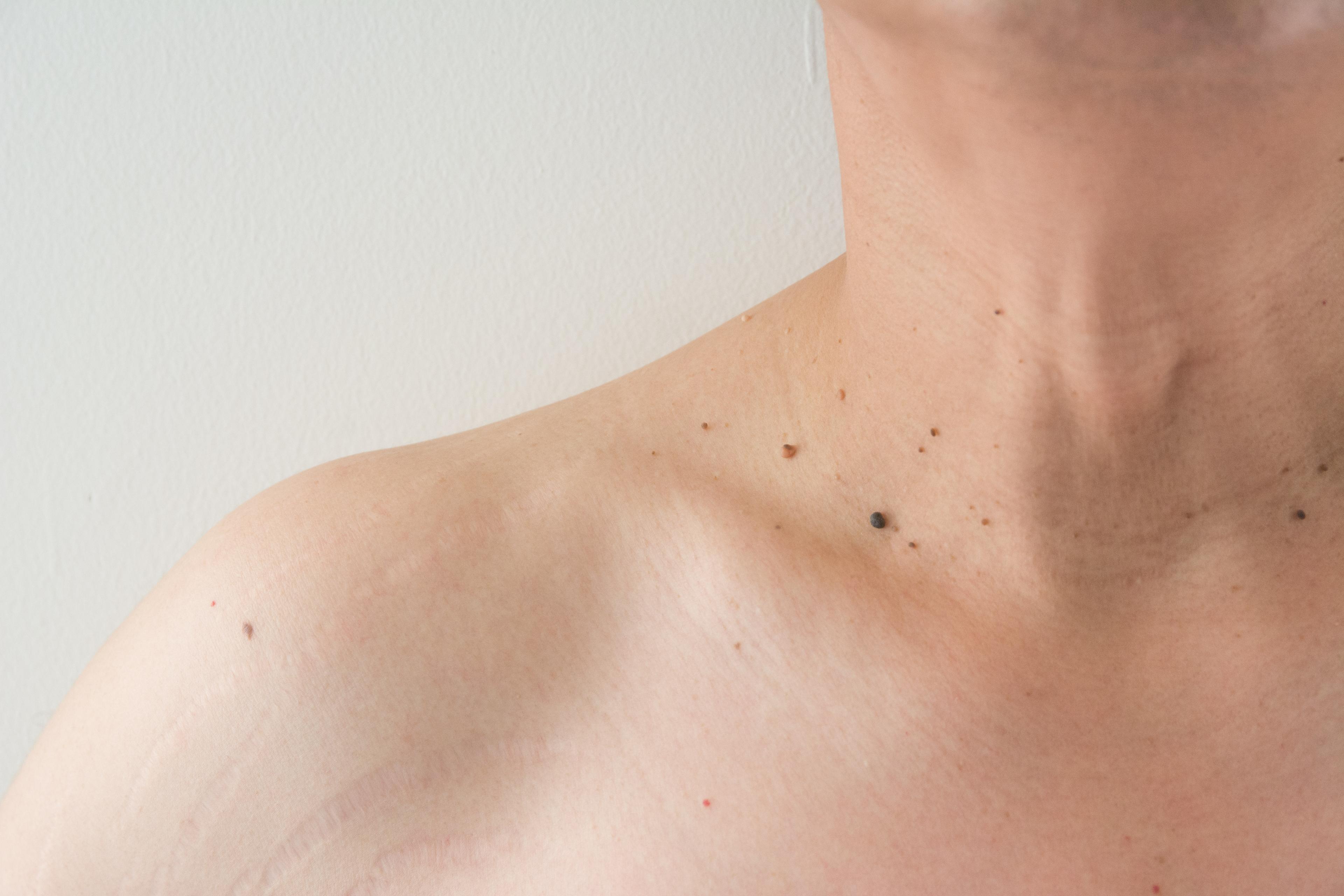 What are skin tags and warts