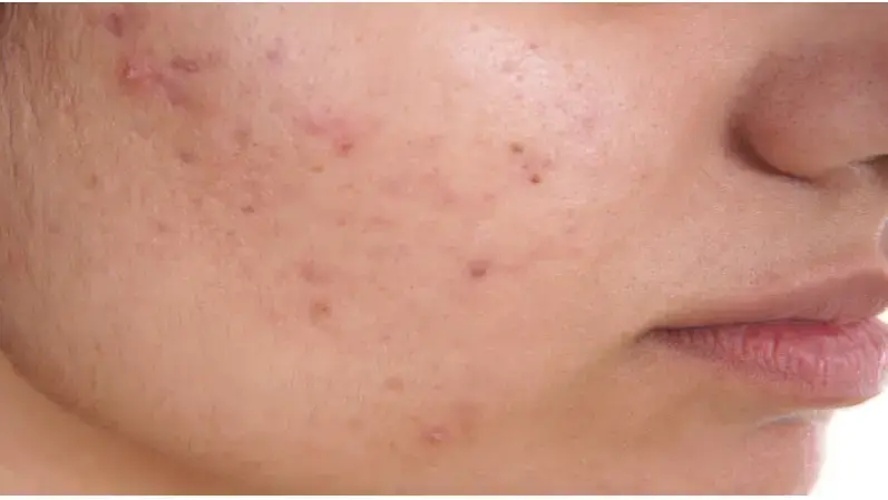 5 Common misconceptions about treating acne scars