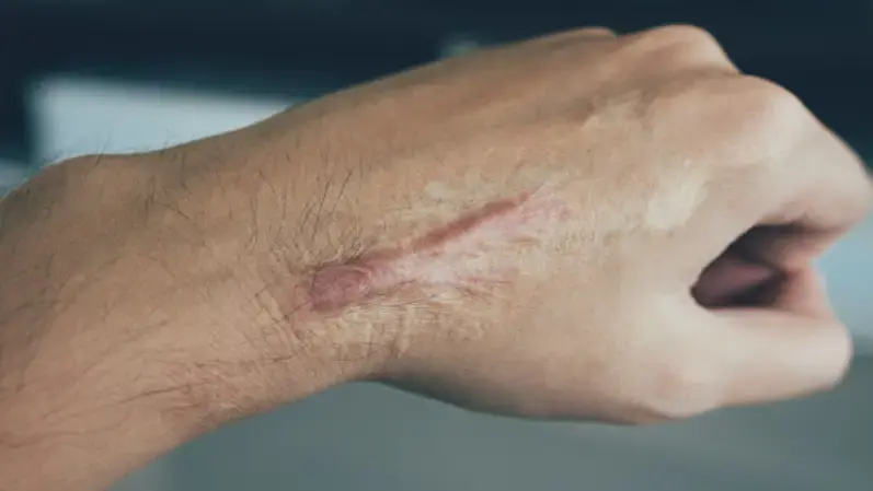 Image of a mans hand with keloids