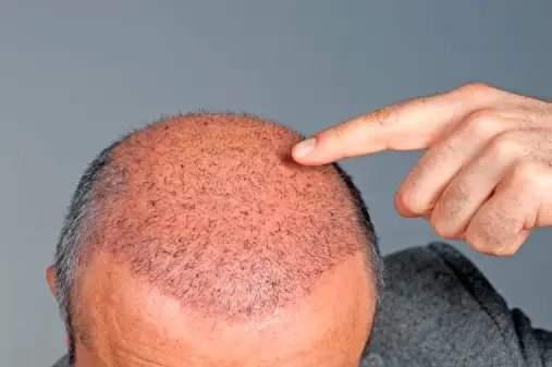 Image of man's head with no hair