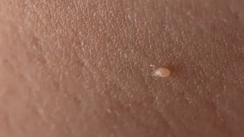 Skin tags on the skin
