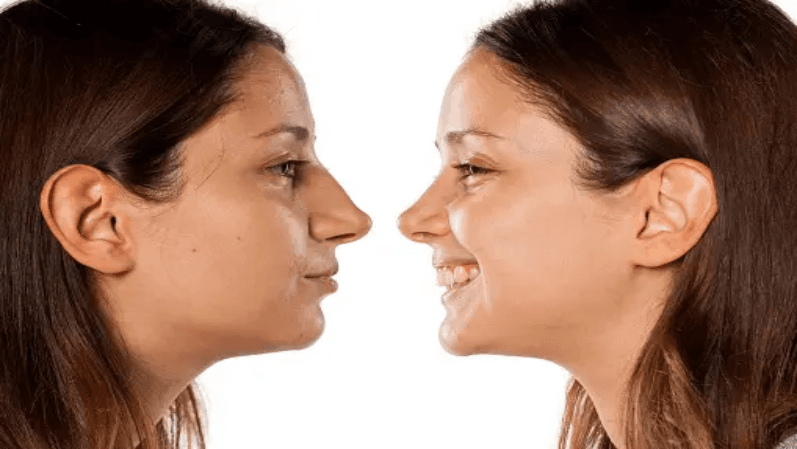 Before & after image of nose surgery 