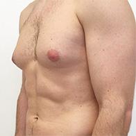 Male Breast