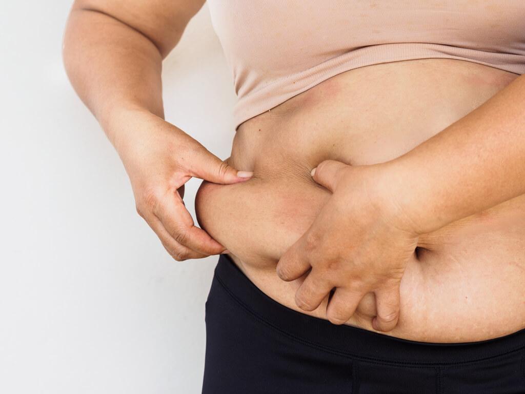 Liposuction - Weight Loss Management