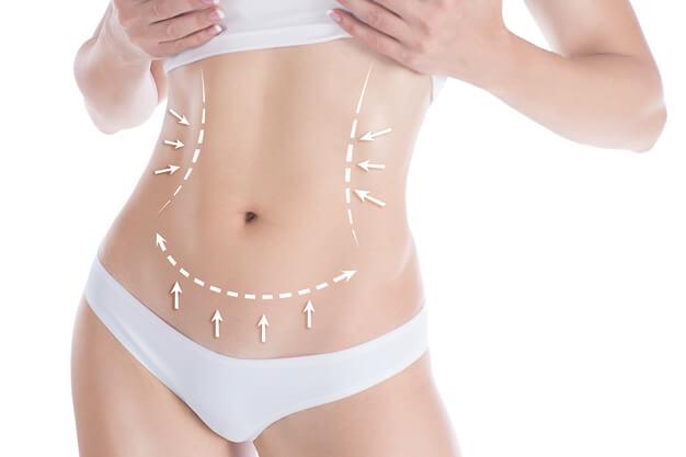 Woman's abdominal area marking possible improvements that can be made with CoolSculpting Fat Freezing Technique