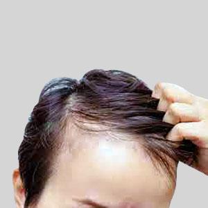Decrease in Hair Density (diffused)