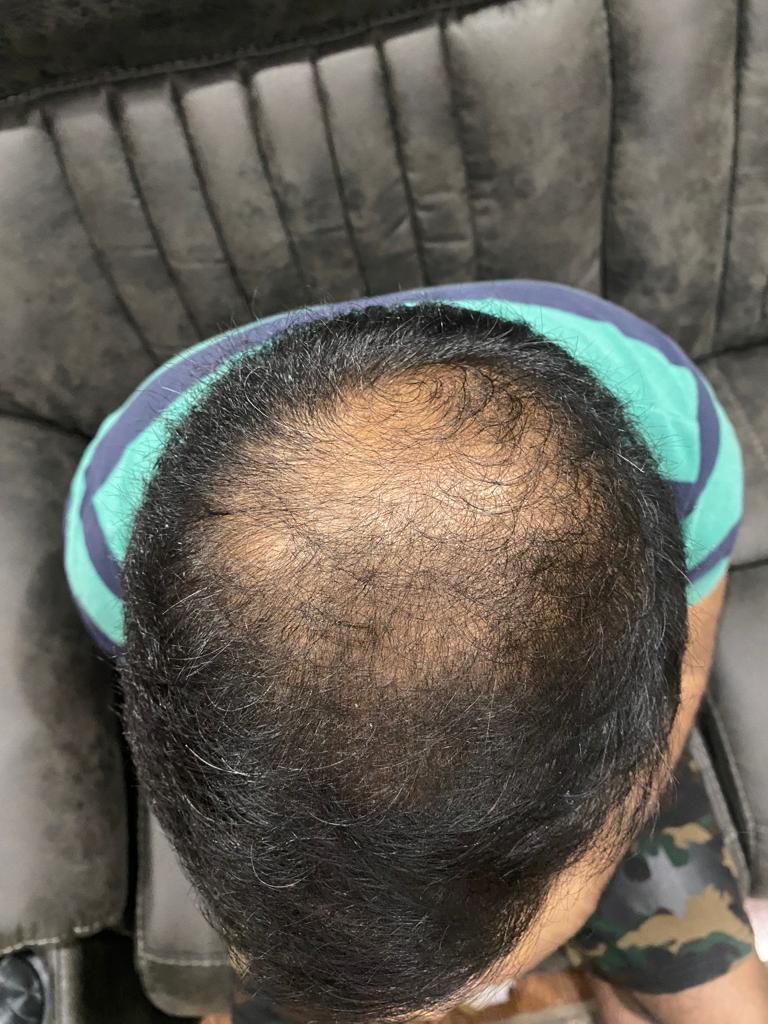 Excessive Diffused Hair Loss