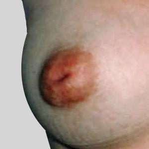Inverted Nipple