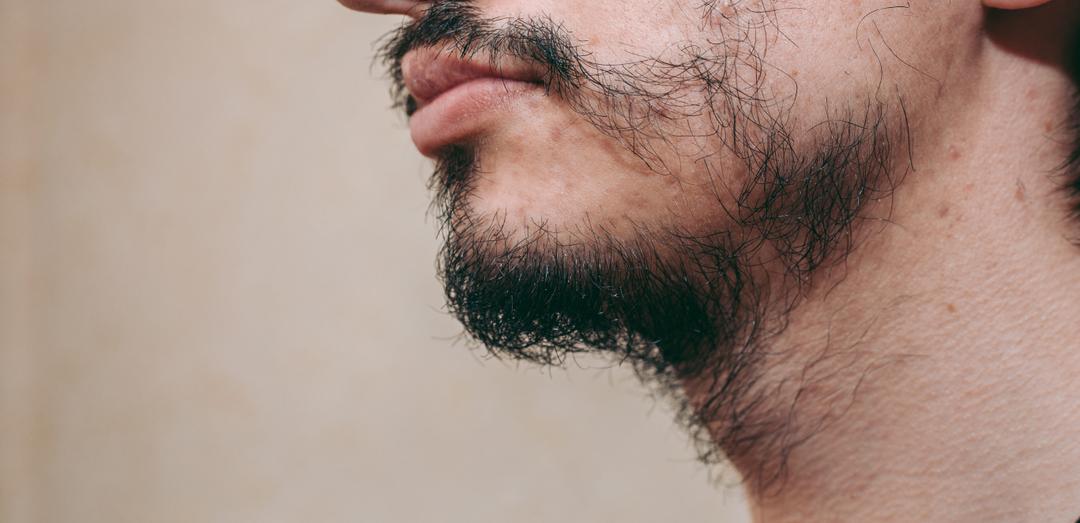 Bald Spots / Sparse Beard or Moustache