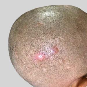 Pain or tenderness over scalp