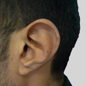 Prominent Ears or Bat Ears