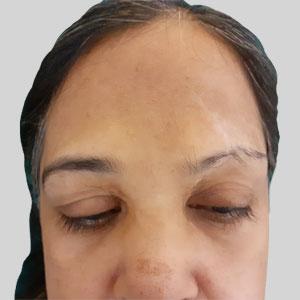 Hair Loss in the Brows