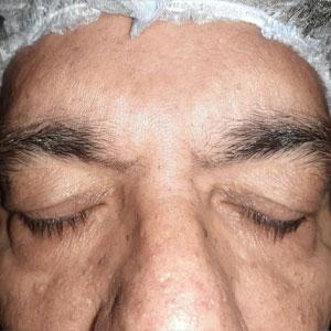 Lower eyelid bags