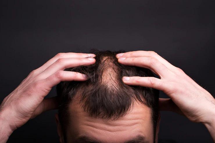 Patchy Areas of Baldness