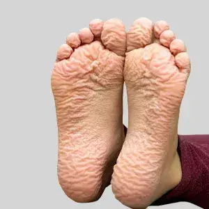 Wrinkled feet
