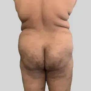 Flaccid Buttocks
