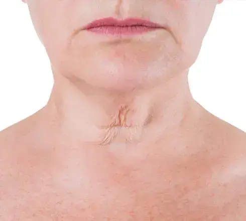 Prominent Neck Lines (neck bands/ Neck Wrinkles)