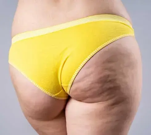 Buttocks Cellulite 