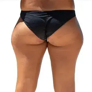 Enlarged Buttocks