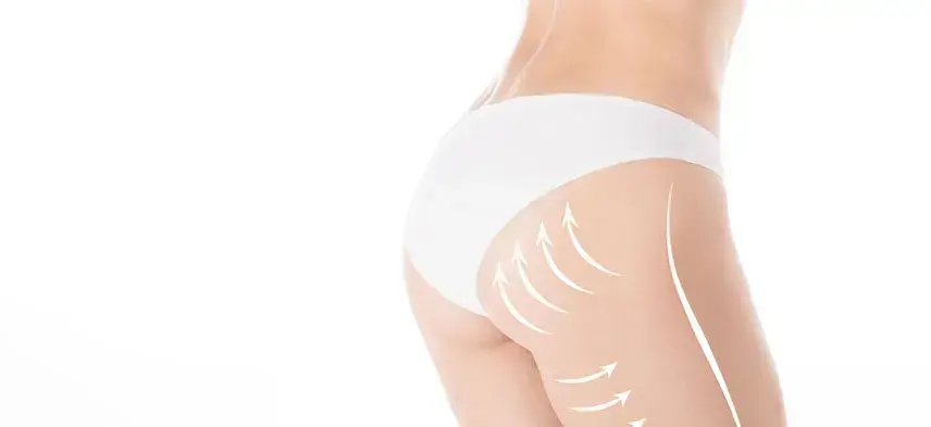 Buttock Augmentation - Before & After