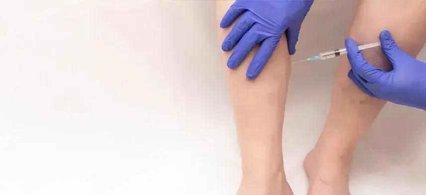 Schlerotherapy - Before & After