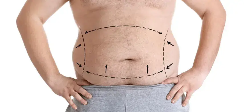 Liposuction with RF skin tightening - Weight Loss Management - Before & After