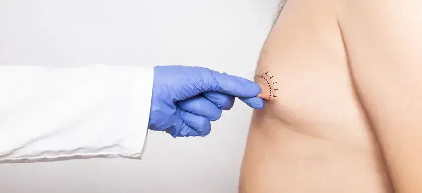 Nipple Reduction Surgery - Before & After