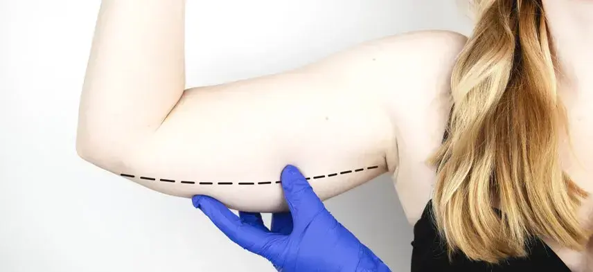 Arm Lift or Brachioplasty - Before & After