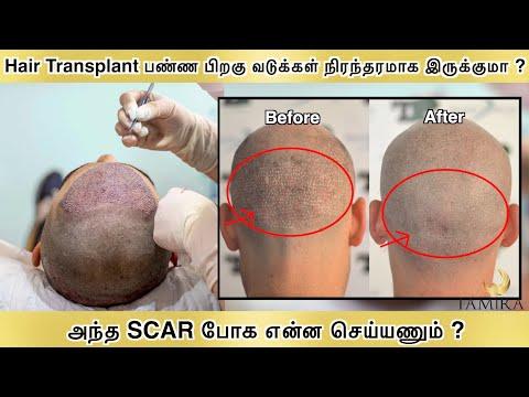 Scalp Micropigmentation - Before & After
