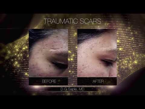 Laser treatment - Skin - Before & After