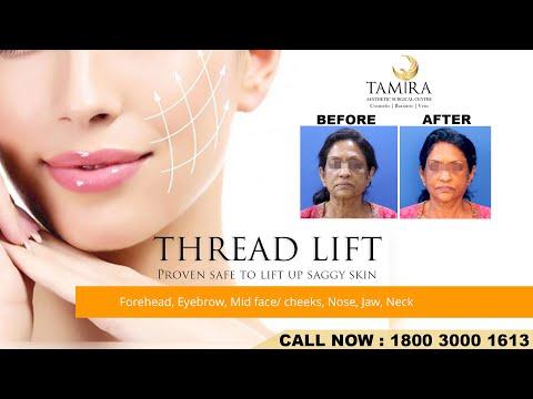 Thread lift - Before & After
